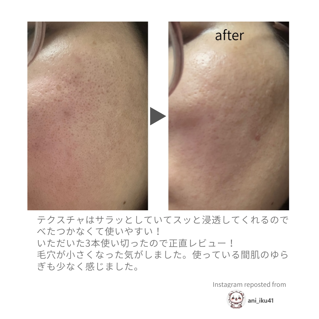 B1化粧水を3本使い切った後の肌の状態を比較した使用者レビュー画像。毛穴の印象がなめらかになった例。
