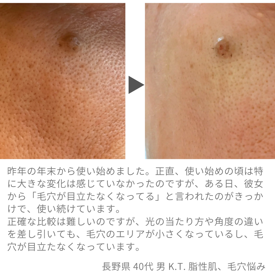 B1化粧水を使用した男性ユーザーによる肌の変化を記録した参考写真。
光の当たり方や撮影環境を揃えて比較した個人の使用記録であり、効果を保証するものではありません。